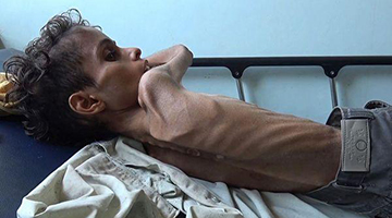 也門戰爭打了4年8.5萬兒童餓死：連哭都沒力氣