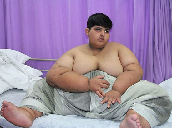 全球最胖 巴基斯坦10歲男童重197公斤